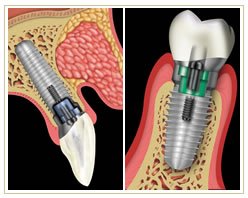 Slider image (5) Cheema Dental Implant Centre